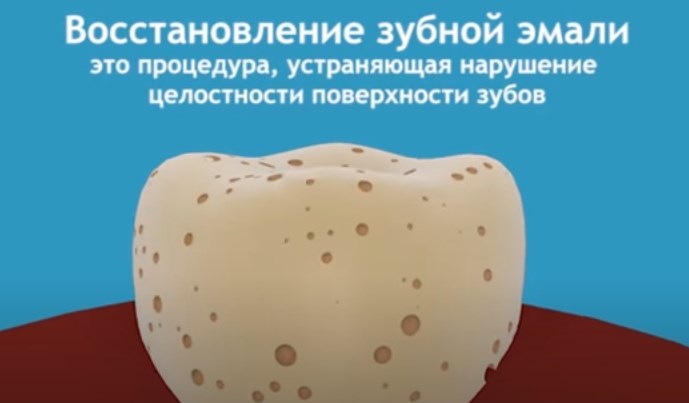 Восстановление зубной эмали